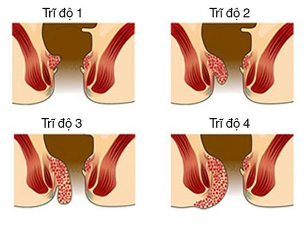 4 cấp độ của bệnh trĩ nội