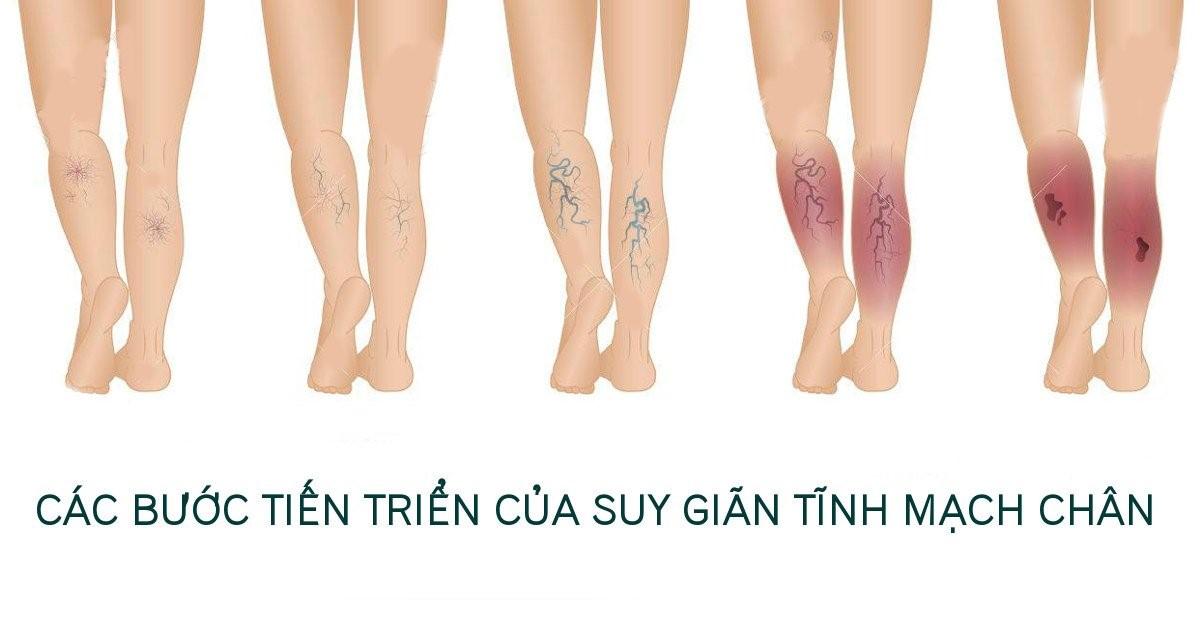 Các bước tiến triển của bệnh suy giãn tĩnh mạch chân