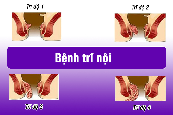 Bệnh trĩ nội là gì?