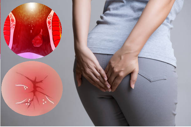 Nếu bị ngứa hậu môn, bạn có thể đang mắc bệnh trĩ!