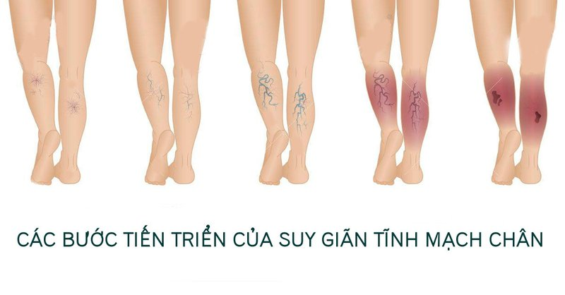 Các bước tiến triển của suy giãn tĩnh mạch chân