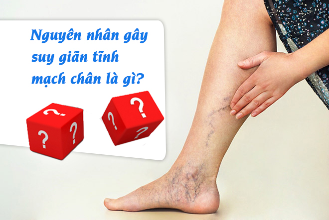 Nguyên nhân gây suy giãn tĩnh mạch chân là gì?