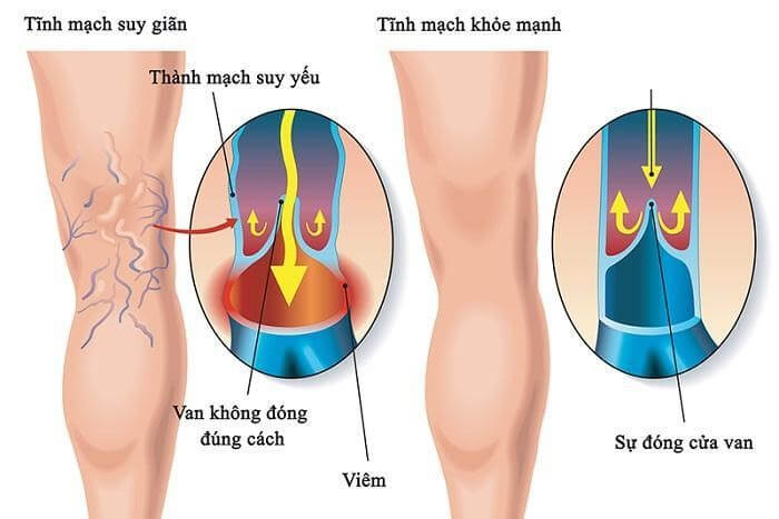 Cơ chế suy giãn tĩnh mạch