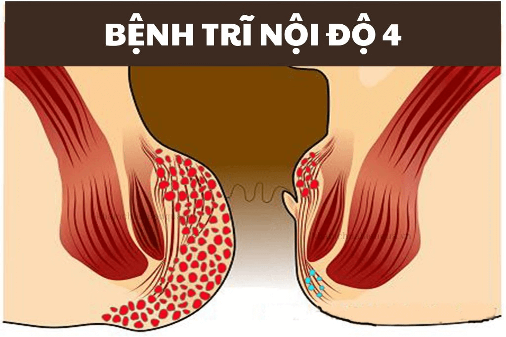 Bệnh trĩ nội độ 4 thường được chỉ định phẫu thuật