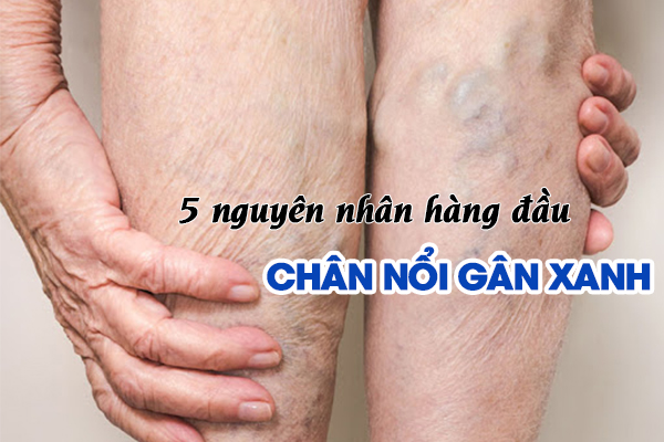 5 nguyên nhân hàng đầu khiến chân nổi gân xanh và cách khắc phục