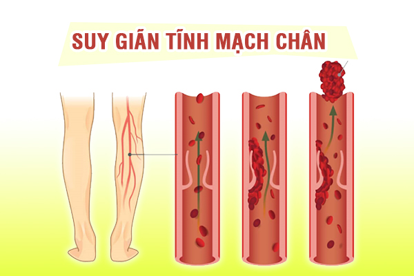 Cảnh báo: Suy giãn tĩnh mạch chân có thể gây biến chứng huyết khối tĩnh mạch sâu nguy hiểm