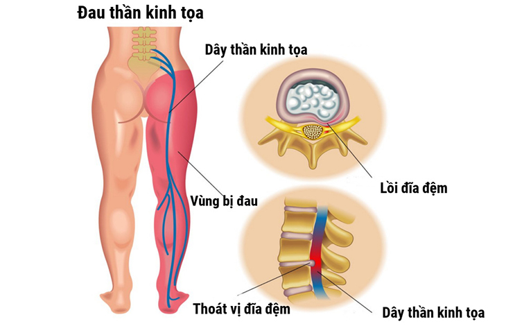  Chuột rút khi ngủ có thể là dấu hiệu của bệnh đau thần kinh tọa