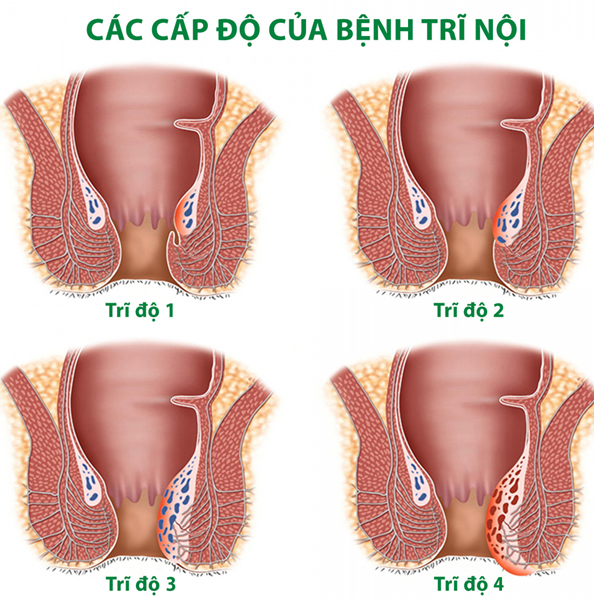 Các cấp độ bệnh trĩ nội