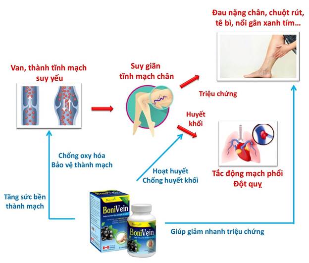 BoniVein + tác động trên mọi khía cạnh của bệnh suy giãn tĩnh mạch chân