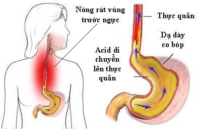 Tư thế ngủ tốt cho người bị trào ngược dạ dày – thực quản