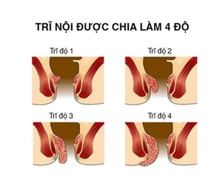 BoniVein cải thiện bệnh trĩ như thế nào?