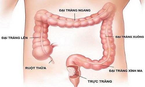 Bệnh viêm đại tràng sigma có nguy hiểm không ? Chế độ ăn uống như thế nào ?