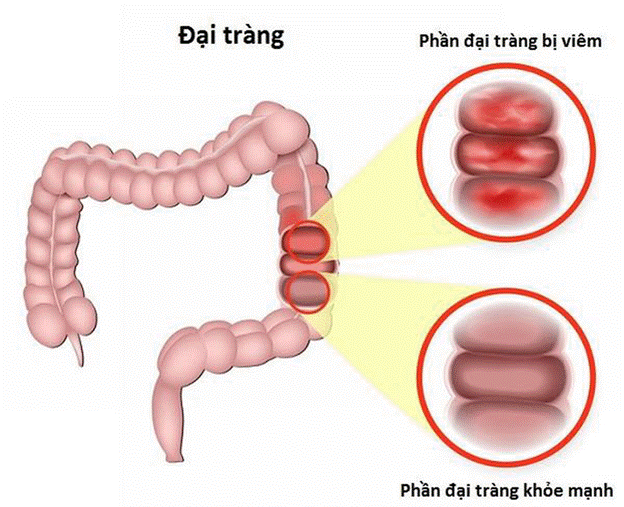 Những lưu ý trong quá trình điều trị viêm đại tràng