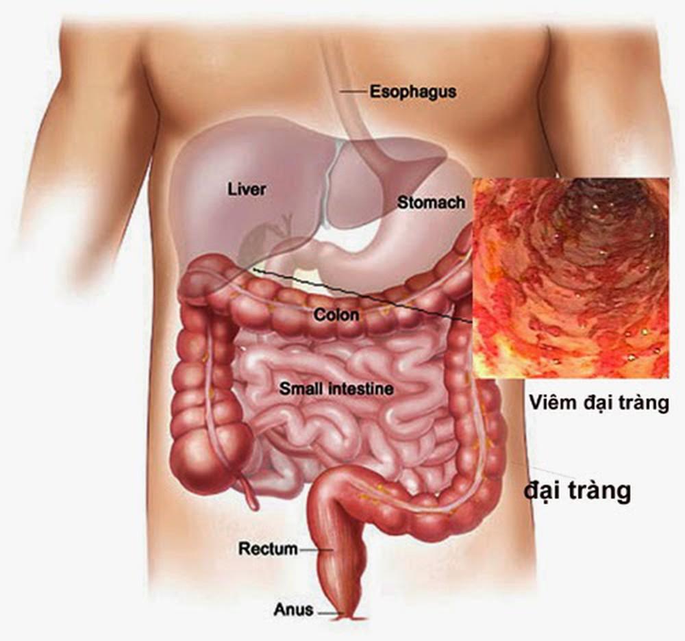 Viêm đại tràng là bệnh gì?