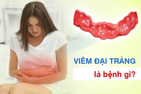 Hình ảnh viêm đại tràng