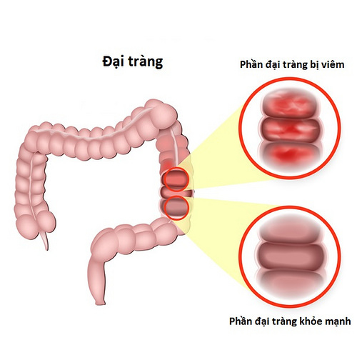 Tôi bị viêm đại tràng mãn tính từ 10 năm nay, đi bệnh viện uống thuốc chỉ đỡ nhưng không khỏi được. Sao bệnh của tôi lại hay tái phát như vậy?