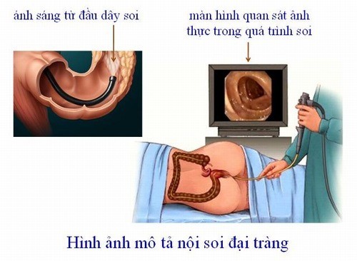 8 điều cần biết trước khi đi nội soi đại tràng?