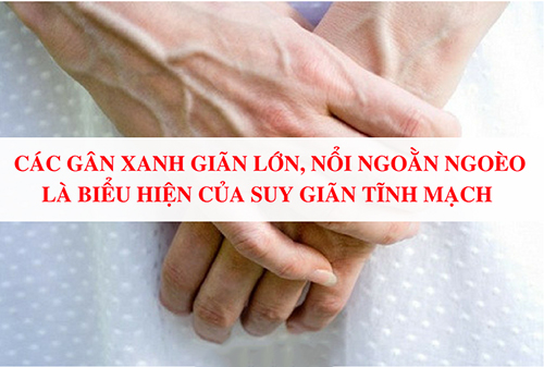 Tìm hiểu về bệnh suy giãn tĩnh mạch tay