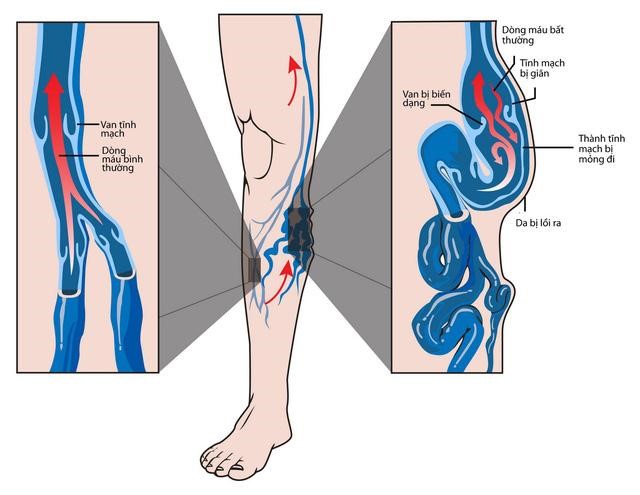 Kết quả hình ảnh cho suy giãn tĩnh mạch