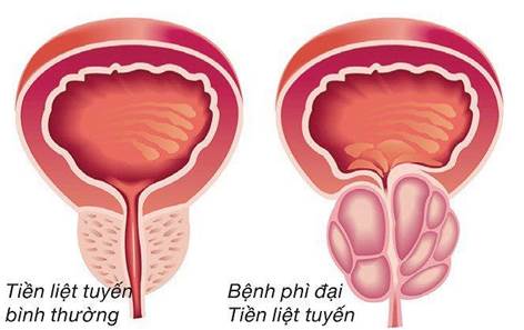 Thực hư việc chữa phì đại tuyến tiền liệt bằng thuốc nam