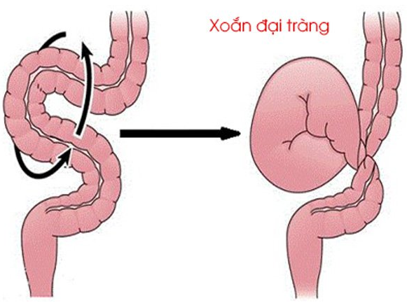 Hình ảnh đại tràng bị xoắn