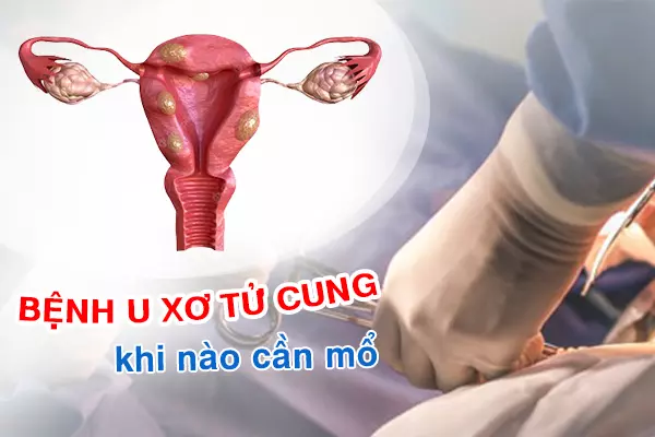 Bệnh u xơ tử cung có nguy hiểm không, khi nào cần mổ?