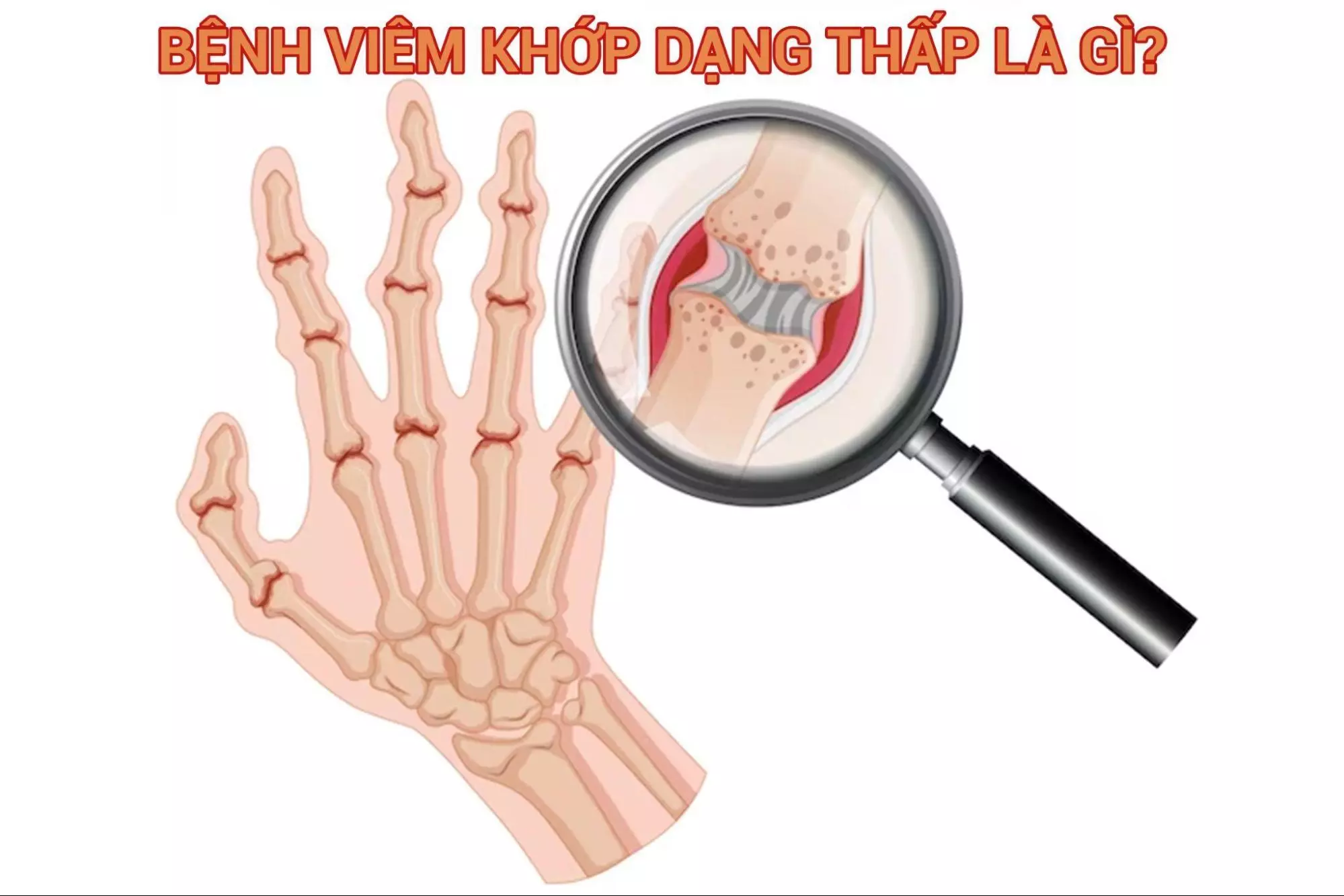 Tìm hiểu về bệnh viêm khớp dạng thấp