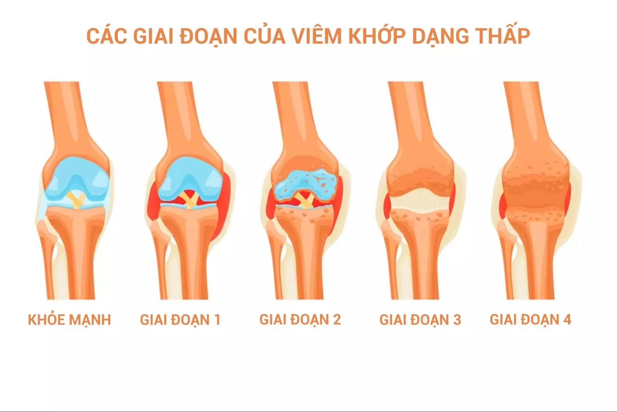 Các giai đoạn của bệnh viêm khớp dạng thấp