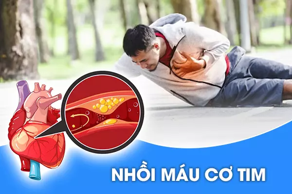 Nhồi máu cơ tim - Hồi chuông cảnh báo cho những người trẻ tuổi