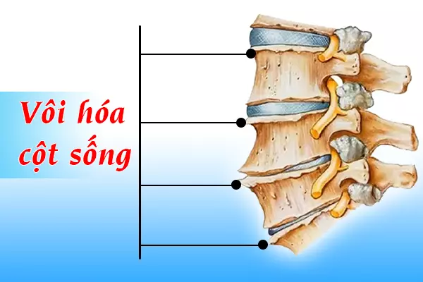 Vôi hóa cột sống - Những thông tin quan trọng mà bạn cần biết!