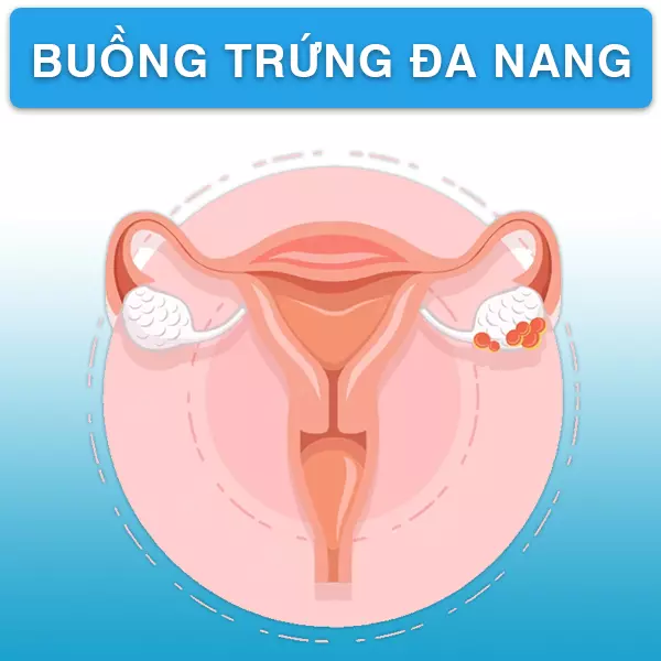 Hội chứng buồng trứng đa nang - bạn biết gì về căn bệnh này?