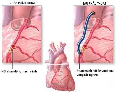 Phẫu thuật bắc cầu mạch vành