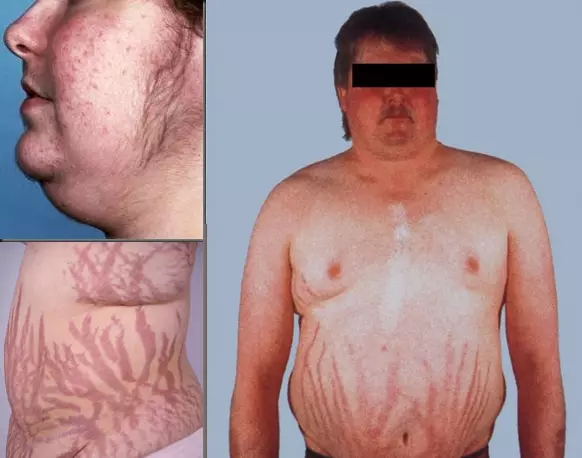 Triệu chứng của hội chứng Cushing