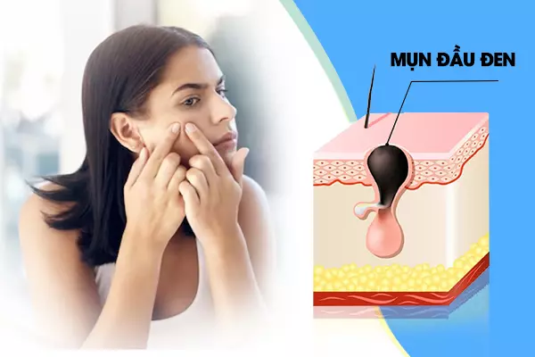 Mách bạn cách trị mụn đầu đen hiệu quả nhất