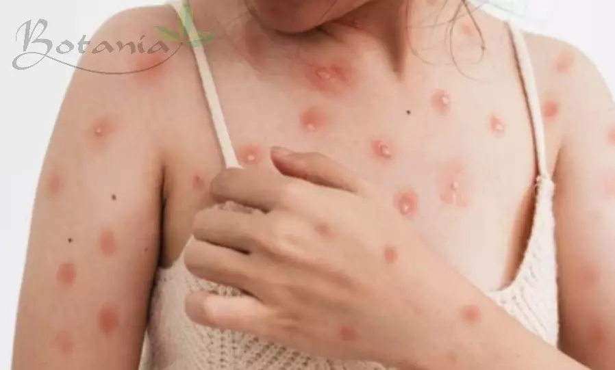 Bệnh đậu mùa khỉ là gì? Bệnh có nguy hiểm không và điều trị như thế nào?