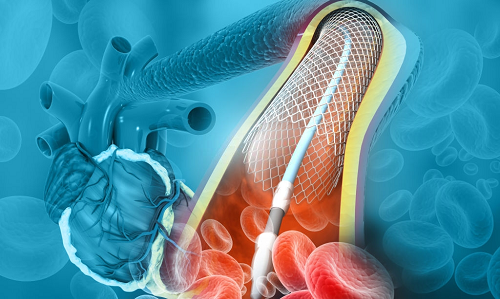 Stent kim loại thường chỉ có khung kim loại trần