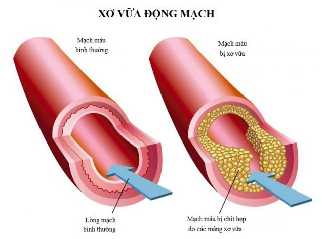 Xơ vữa động mạch là nguyên nhân chính gây thiếu máu não