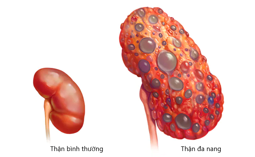 Thận đa nang là bệnh gì? Triệu chứng và cách điều trị