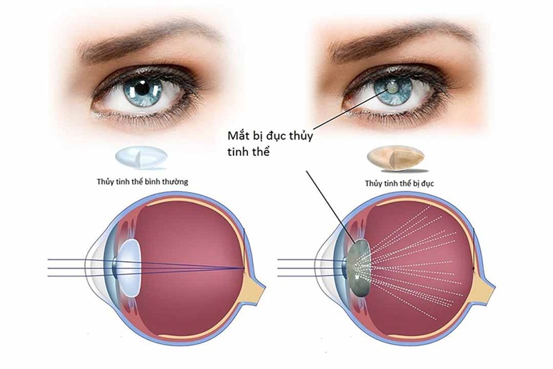 Minh họa đục thủy tinh thể.