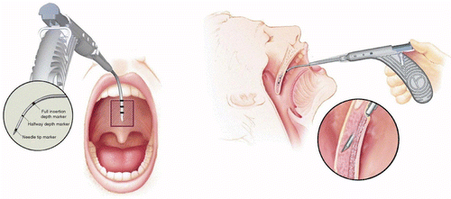 Cấy ghép vòm miệng