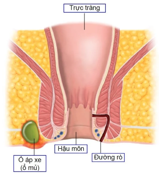 Bệnh rò hậu môn