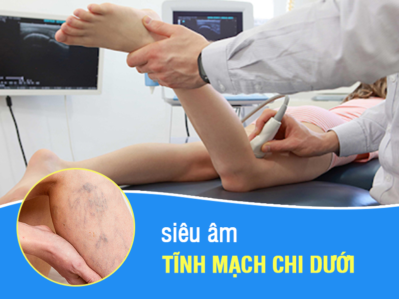 Siêu âm tĩnh mạch chi dưới để chẩn đoán suy giãn tĩnh mạch