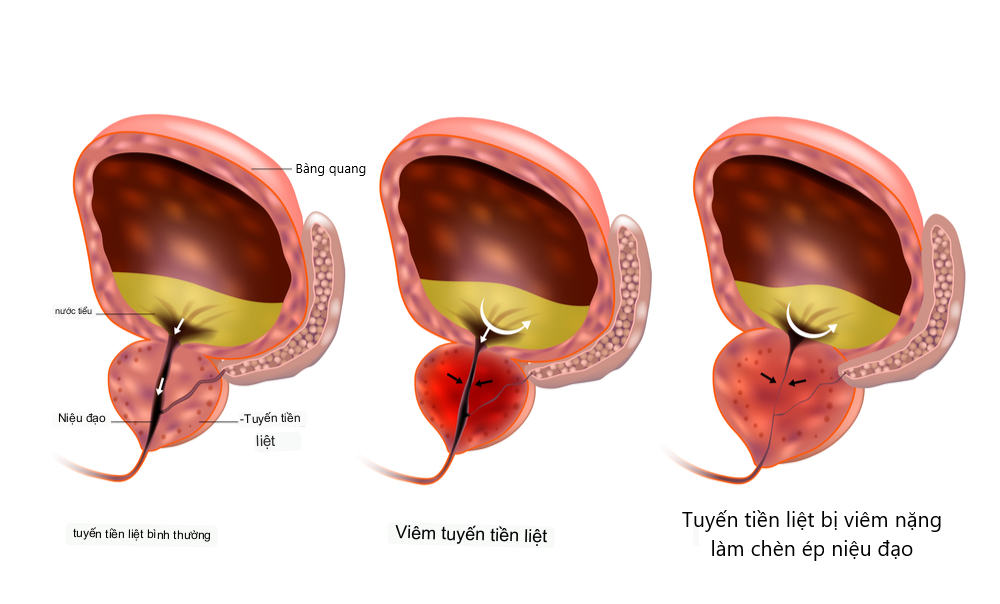 Bệnh viêm tuyến tiền liệt