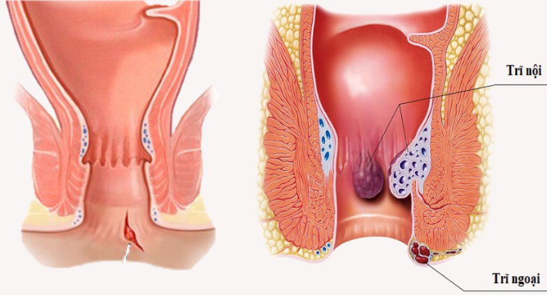 Cần phân biệt giữa nứt kẽ hậu môn (trái) và bệnh trĩ (phải)