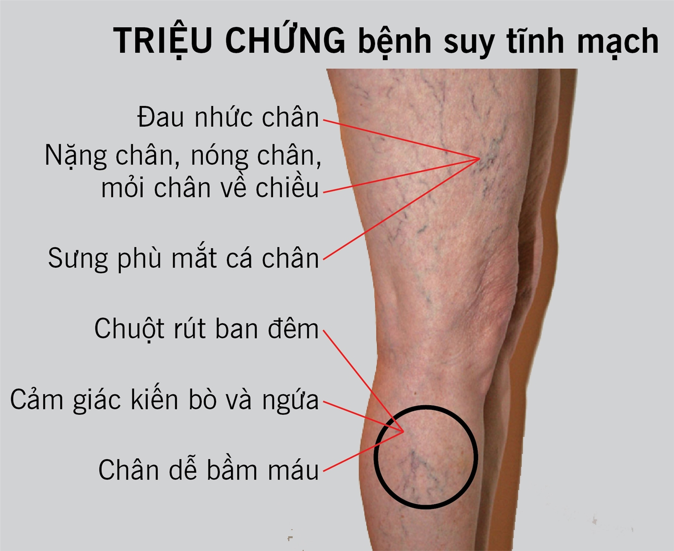 triệu chứng bệnh suy giãn tĩnh mạch