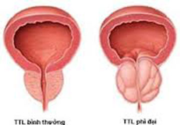 U xơ tuyến tiền liệt - Đồng hành với tuổi tác