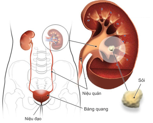 Suy thận-biến chứng nặng nề của bệnh gút