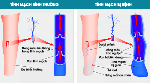 Biến chứng của suy giãn tĩnh mạch, đừng chủ quan mà hối hận cả đời