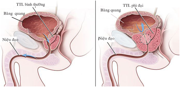 Đừng để tuyến tiền liệt sưng như quả quýt