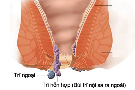 Trĩ hỗn hợp là gì? Những điều cần biết về trĩ hỗn hợp